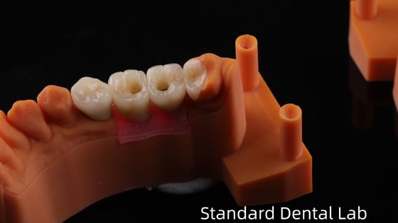 Screw Retained Dental Implant Crown with PFZ Porcelain Layered Zirconia 5-Year Gurantee and 3D Print Model