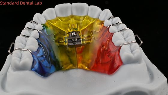 Teeth Expansion And Distalization Orthodontist Palate Expander China Dental Lab