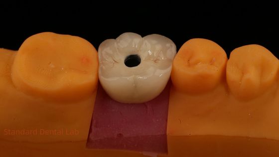 Screw Retained PFZ Porcelain Layered Zirconia Dental Implant Crown from Dental Lab ISO FDA CE Certified with 5-Year Guarantee