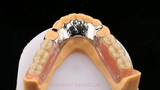 Metal Alloys Cobalt Chromium Partial Denture Ivoclar Scheftner Comfortable Cast Metal Framewrok
