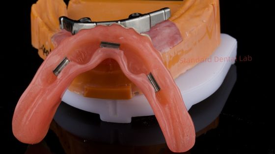 Ivoclar Digital Dental Implant Bar Denture with Attachments Full Acrylic Denture Titanium Implant Supported Dentures