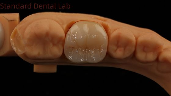 Dental Digital Full Zirconia Crown with Noritake Porcelain 3D Print Model 5 Year Guarantee