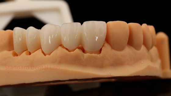 High Aesthetic Anterior Teeth Full Contour Zirconia Crown with Customized Vita Shade Dental Lab