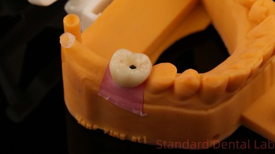 Dental Implant Screw Retained Crown PFZ Porcelain Layered Zirconia With 3D Print Model