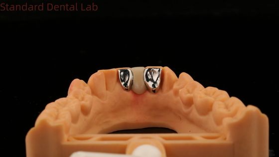Dental PFM Maryland Bridge High Esthetics FDA Certified With Vita Porcelian China Dental Lab