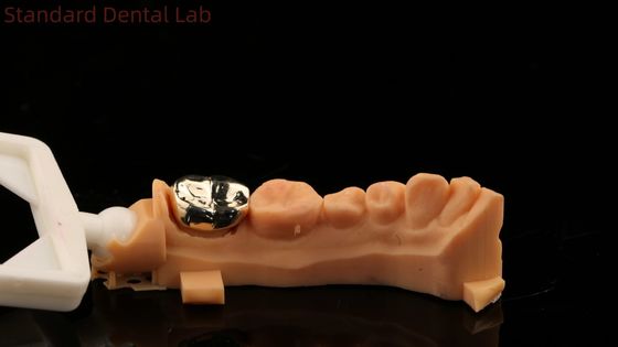 High Nobel Yellow Gold Crown Tooth Professional Ni Be Free ISO And FDA Approved China Dental Lab