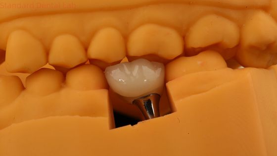 Screw Retained Dental Implant Crown Dental PFM Crown With 3D Print Model