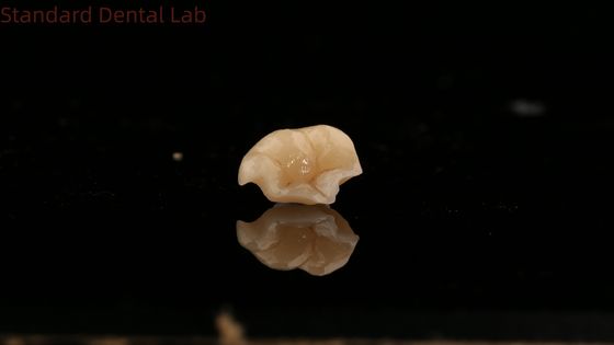 Strength Emax Ceramic Crown Dental Onlay with Excellent Stain Resistance China Dental Lab