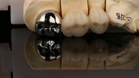 Vita Porcelian Full Metal Crown With Post Core 3 Years Guarantee from Dental Lab