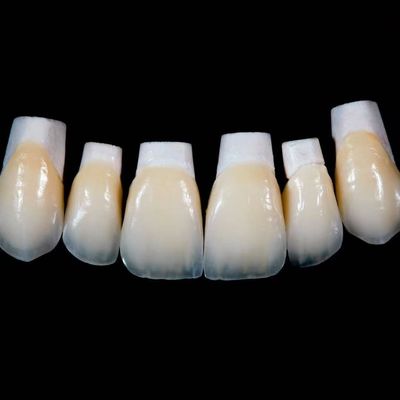 High Translucency Emax Porcelain Veneers Crown with Better Materials by Ivoclar Vivadent