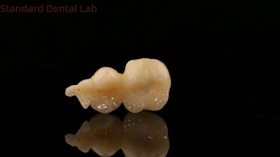 Dental Digital Full Zirconia Crown With 3D Print Model SDL Dental Lab Zirconia Onlay