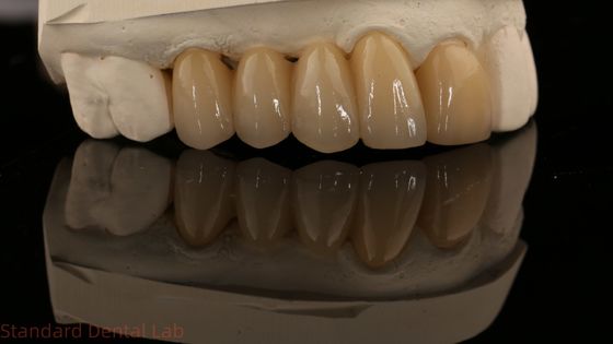 Noritake Porcelian Full Contour Zirconia Crown High Aesthetic Natural Customized Zirconia Dental Bridge