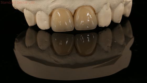 Full Contour Zirconia Crown and High Aesthetic Natural Dental Bridge 5 Year Guarantee