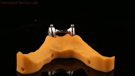 Ivoclar Digital Dental Implant Bar Denture with Attachments , Full Acrylic Titanium Implant Supported Dentures