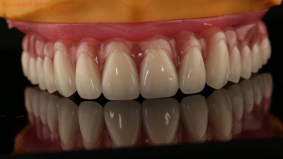 Acrylic Partial Implant Over Denture Titianium Bar Full Denture Teeth Set Up Screw Retained