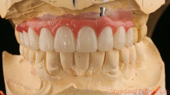 Good Fitting Precise Esthetic Zirconia Porcelain Crown Pink Porcelian With Bleaching Shade