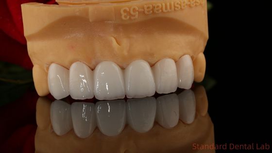 Full Contour Zirconia Crown Translucency 3D PRO No Porcelian Overlay Standard Dental Lab