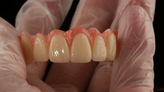 Porcelain All On Four Zirconia Bridge High Esthetics Dental Implant Bridge